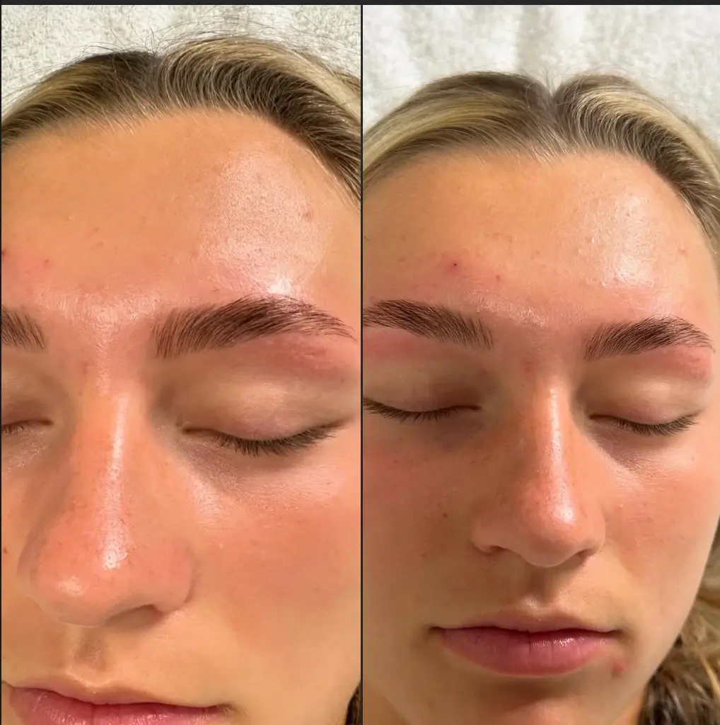 Side-by-side close-up photos of a person's face, showing their forehead, eyebrows, and closed eyes before and after a cosmetic eyebrow treatment. - Jax Salon and Spa